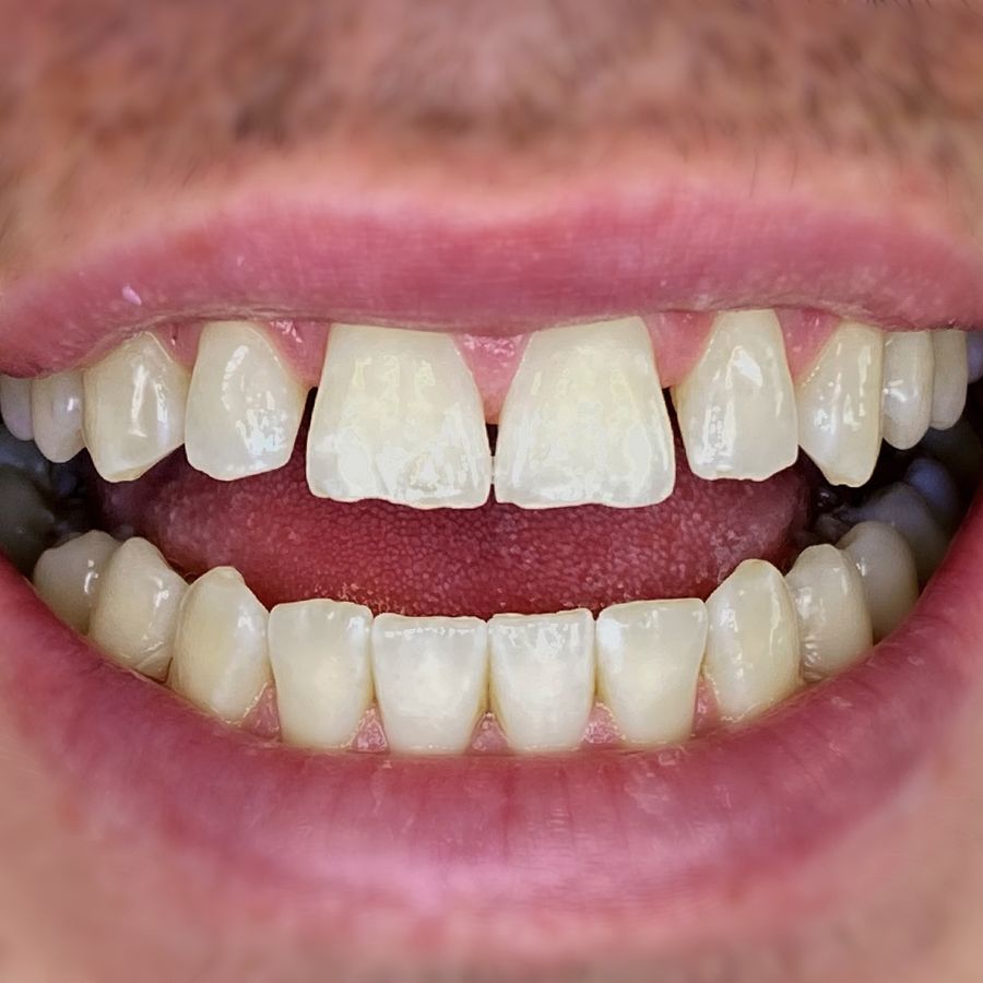 Composite bonding - Rickie - Before - 3Dental